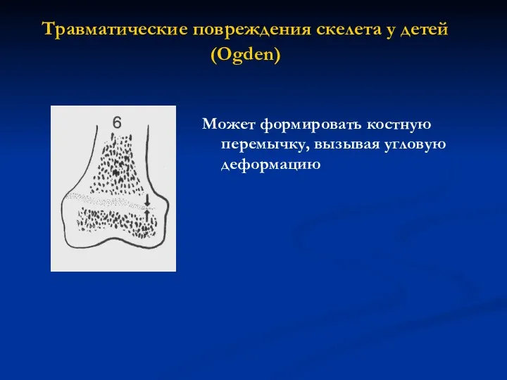 Травматические повреждения скелета у детей (Ogden) Может формировать костную перемычку, вызывая угловую деформацию