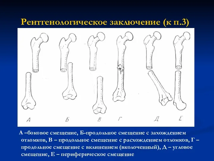 Рентгенологическое заключение (к п.3) А –боковое смещение, Б-продольное смещение с