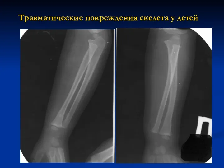 Травматические повреждения скелета у детей