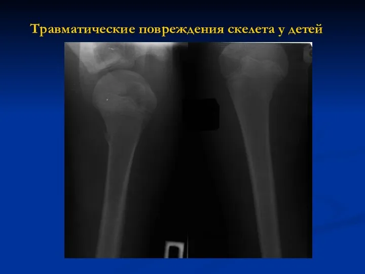 Травматические повреждения скелета у детей