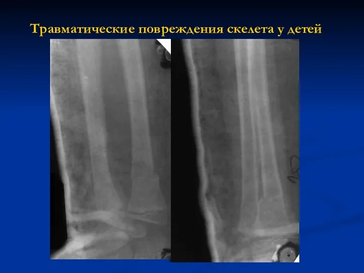 Травматические повреждения скелета у детей