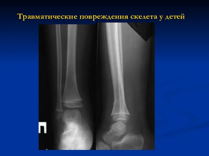 Травматические повреждения скелета у детей