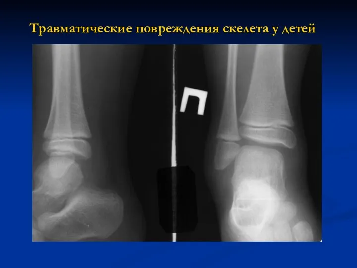 Травматические повреждения скелета у детей