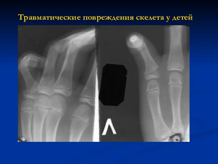 Травматические повреждения скелета у детей