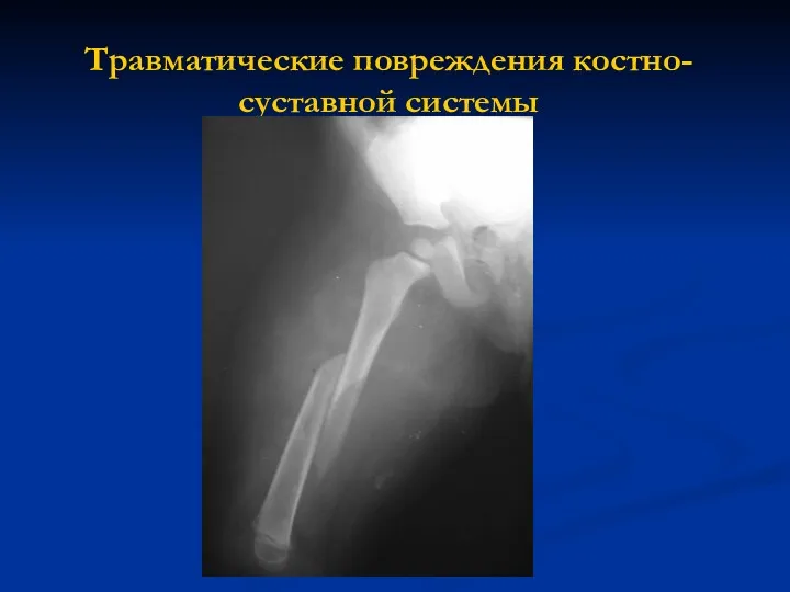 Травматические повреждения костно-суставной системы