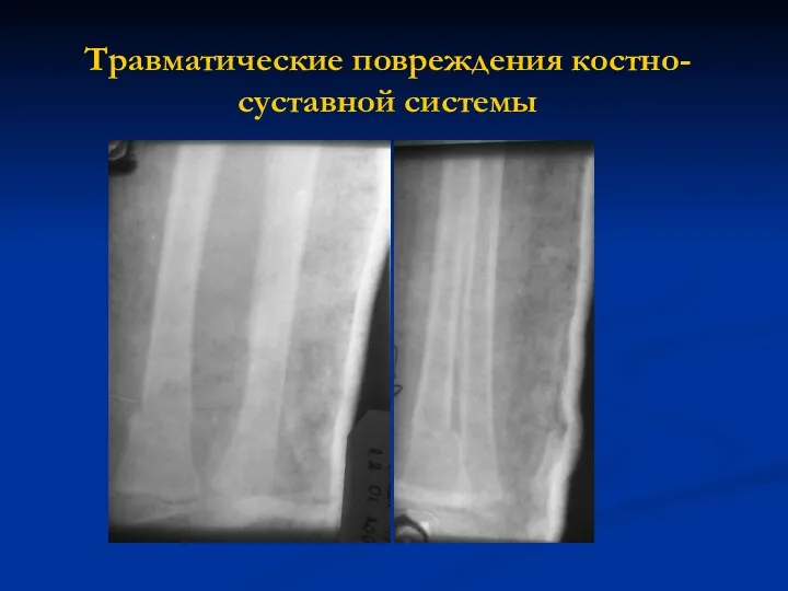 Травматические повреждения костно-суставной системы