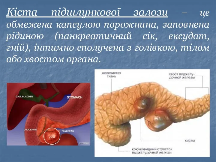 Кіста підшлункової залози – це обмежена капсулою порожнина, заповнена рідиною