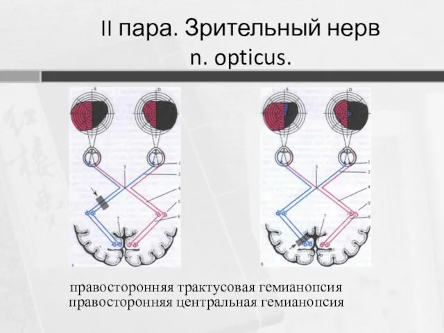 правосторонняя трактусовая гемианопсия правосторонняя центральная гемианопсия II пара. Зрительный нерв n. opticus.