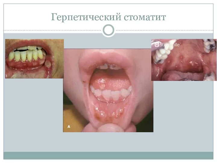 Герпетический стоматит