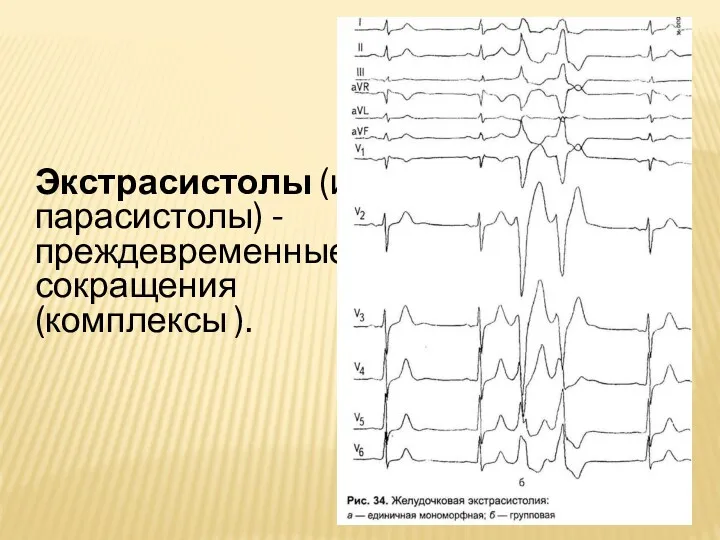 Экстрасистолы (и парасистолы) - преждевременные сокращения (комплексы ).