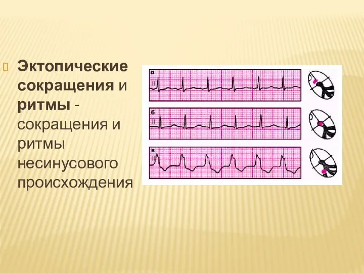 Эктопические сокращения и ритмы - сокращения и ритмы несинусового происхождения