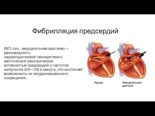 Фибрилляция предсердий (ФП; син.: мерцательная аритмия) — разновидность наджелудочковой тахиаритмии