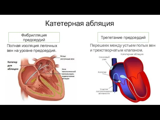 Катетерная абляция Фибрилляция предсердий Трепетание предсердий Полная изоляция легочных вен