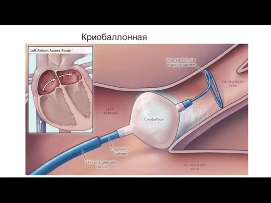 Криобаллонная абляция