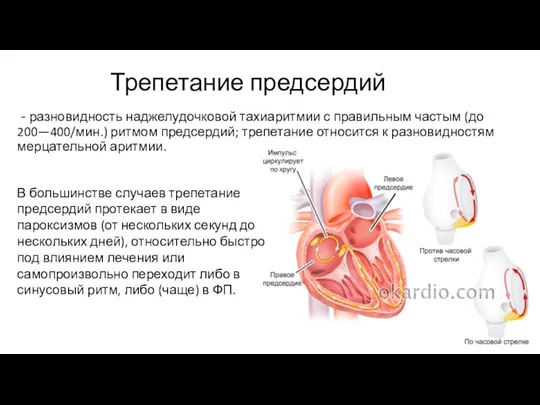 Трепетание предсердий - разновидность наджелудочковой тахиаритмии с правильным частым (до