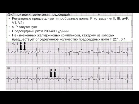 ЭКГ-признаки трепетания предсердий: Регулярные предсердные пилообразные волны F (отведения II,
