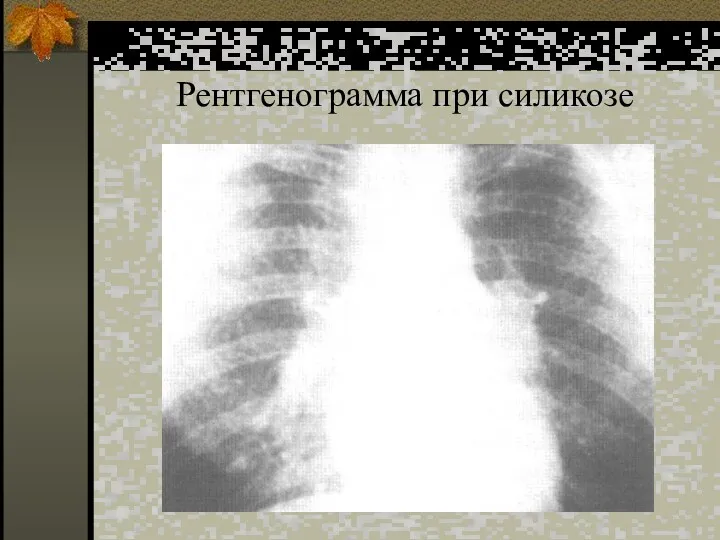 Рентгенограмма при силикозе