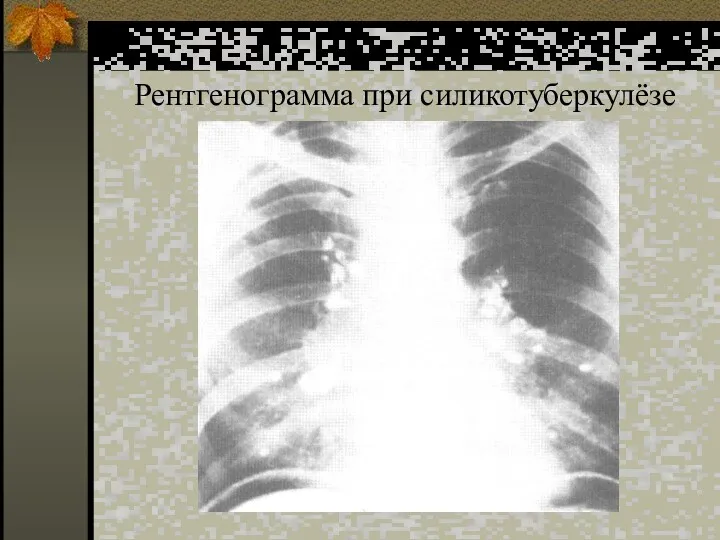 Рентгенограмма при силикотуберкулёзе