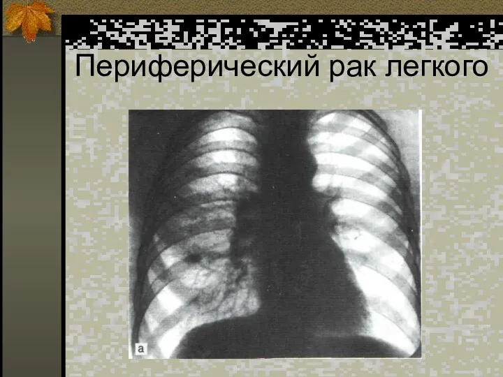 Периферический рак легкого