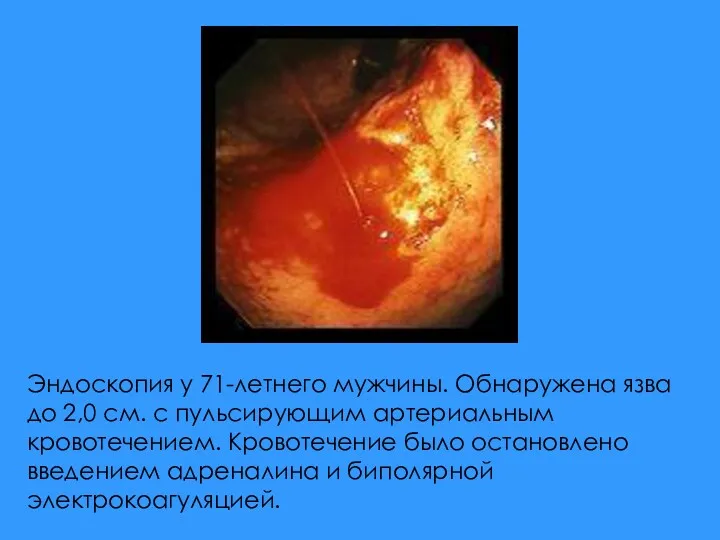 Эндоскопия у 71-летнего мужчины. Обнаружена язва до 2,0 см. с пульсирующим артериальным кровотечением.