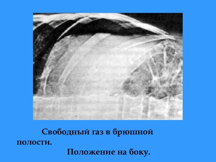 Свободный газ в брюшной полости. Положение на боку.