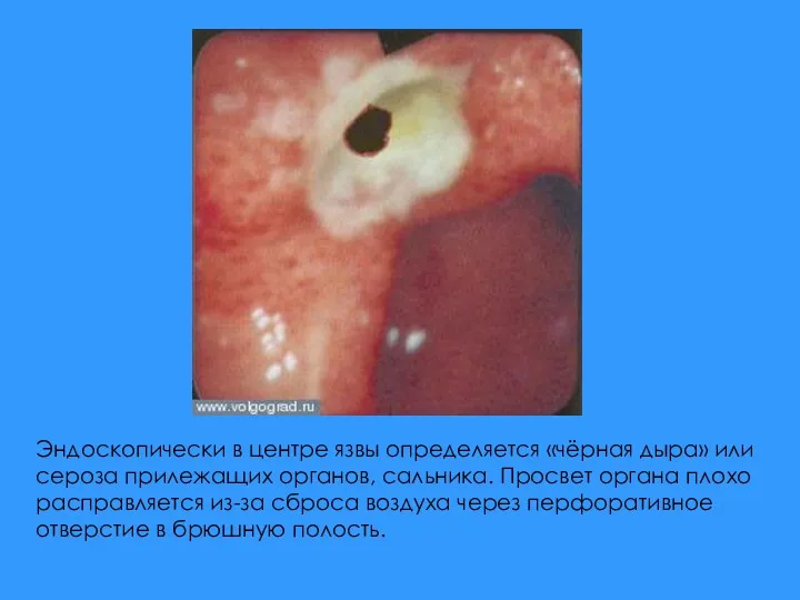 Эндоскопически в центре язвы определяется «чёрная дыра» или сероза прилежащих органов, сальника. Просвет