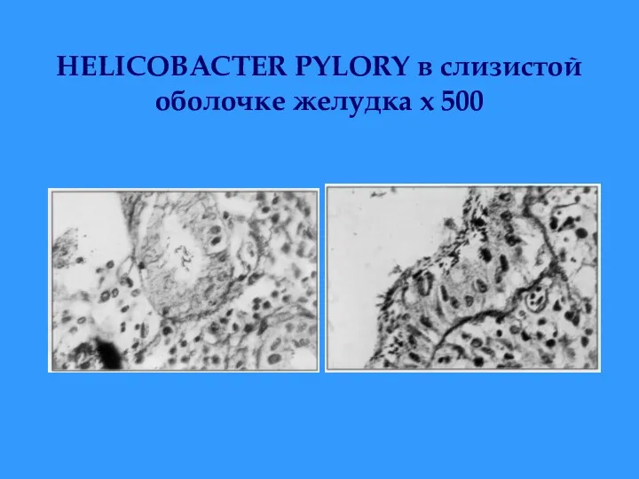 HELICOBACTER PYLORY в слизистой оболочке желудка х 500