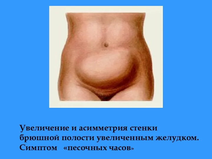 Увеличение и асимметрия стенки брюшной полости увеличенным желудком. Симптом «песочных часов»