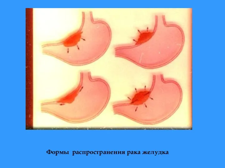 Формы распространения рака желудка