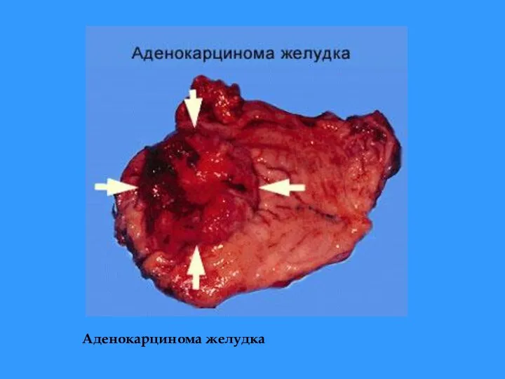 Аденокарцинома желудка