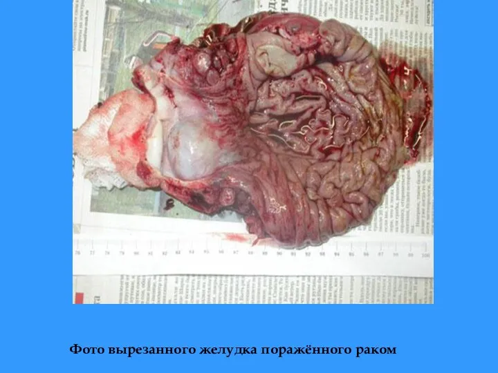 Фото вырезанного желудка поражённого раком