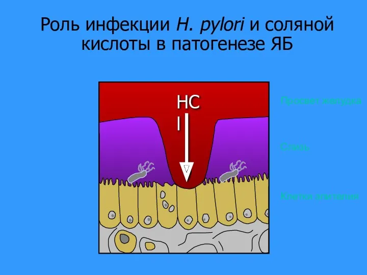 Роль инфекции H. pylori и соляной кислоты в патогенезе ЯБ Клетки эпителия Слизь Просвет желудка HCl