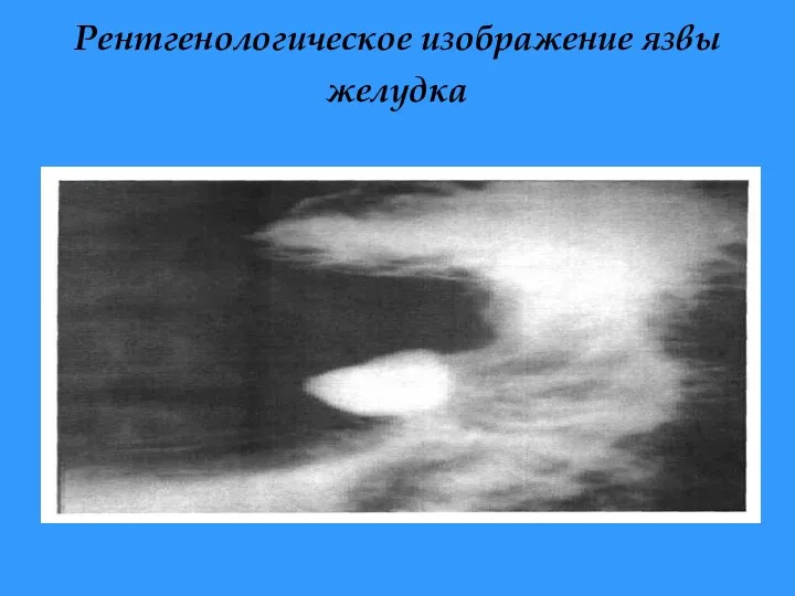 Рентгенологическое изображение язвы желудка