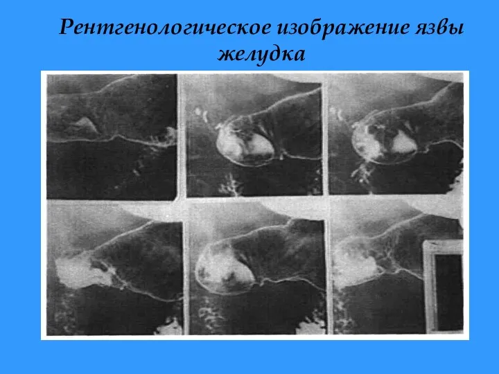 Рентгенологическое изображение язвы желудка