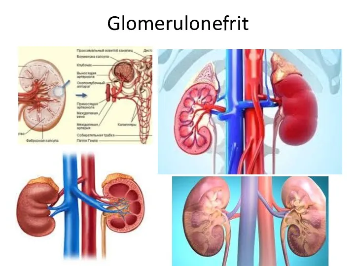 Glomerulonefrit