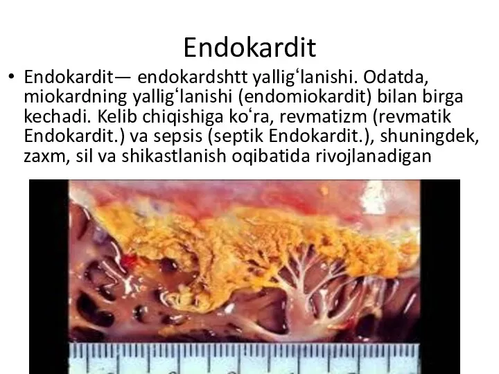 Endokardit Endokardit— endokardshtt yalligʻlanishi. Odatda, miokardning yalligʻlanishi (endomiokardit) bilan birga kechadi. Kelib chiqishiga