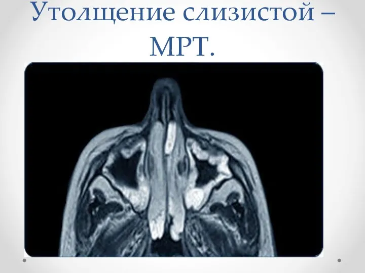 Утолщение слизистой – МРТ.