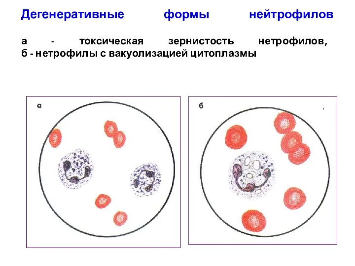 Дегенеративные формы нейтрофилов а - токсическая зернистость нетрофилов, б - нетрофилы с вакуолизацией цитоплазмы