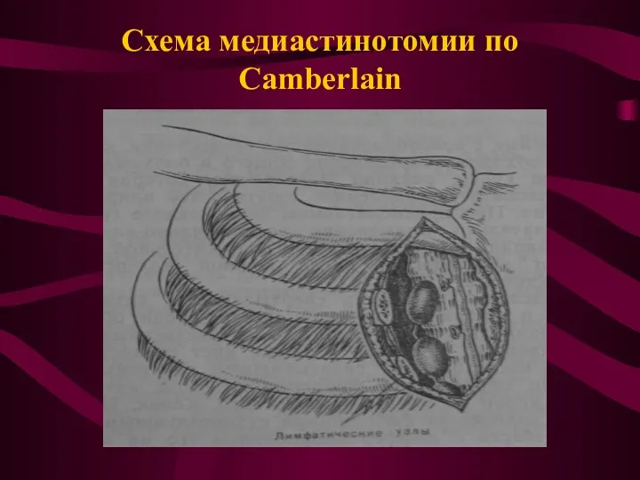 Схема медиастинотомии по Camberlain