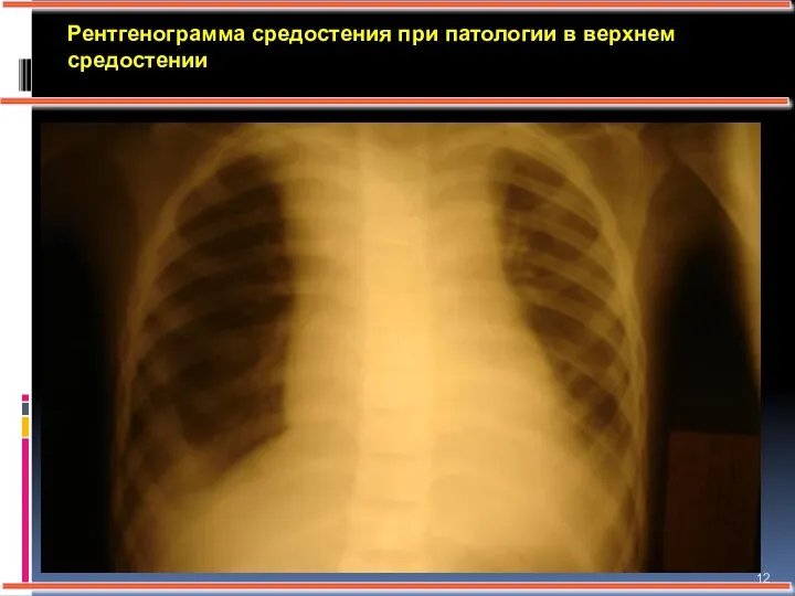 Рентгенограмма средостения при патологии в верхнем средостении