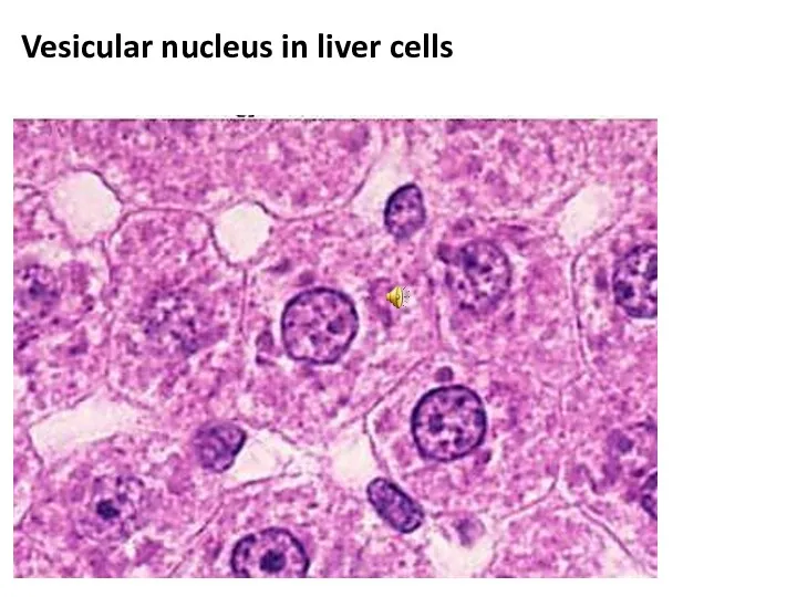 Vesicular nucleus in liver cells