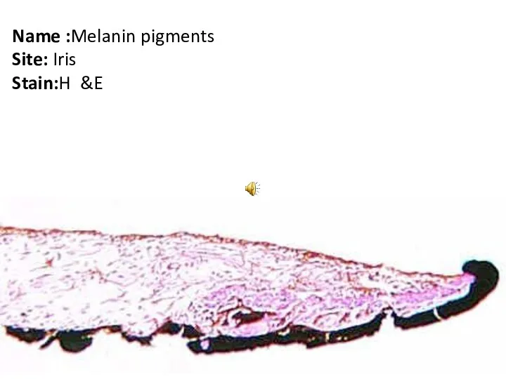 Name :Melanin pigments Site: Iris Stain:H &E
