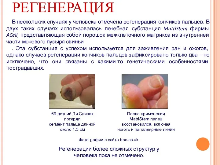 РЕГЕНЕРАЦИЯ В нескольких случаях у человека отмечена регенерация кончиков пальцев. В двух таких
