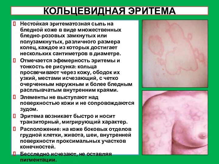 КОЛЬЦЕВИДНАЯ ЭРИТЕМА Нестойкая эритематозная сыпь на бледной коже в виде
