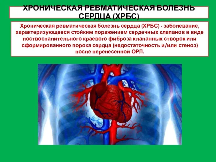 ХРОНИЧЕСКАЯ РЕВМАТИЧЕСКАЯ БОЛЕЗНЬ СЕРДЦА (ХРБС) Хроническая ревматическая болезнь сердца (ХРБС)