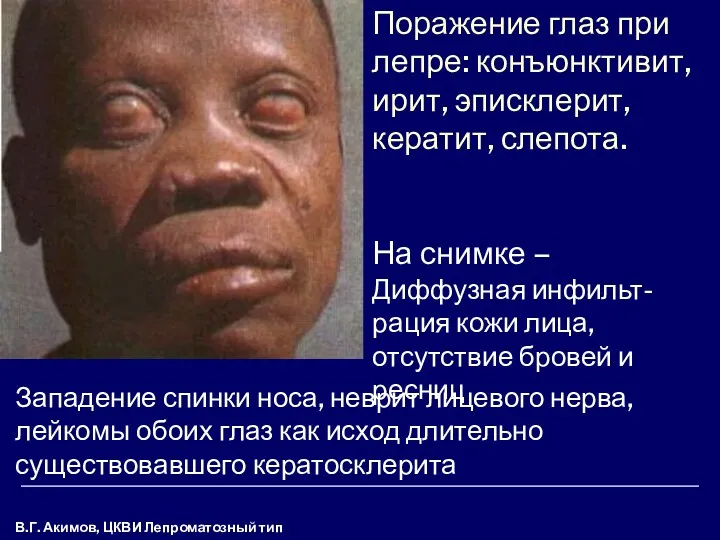 В.Г. Акимов, ЦКВИ Лепроматозный тип лепры Поражение глаз при лепре: