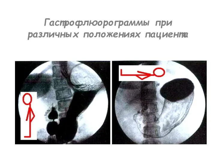 Гастрофлюорограммы при различных положениях пациента