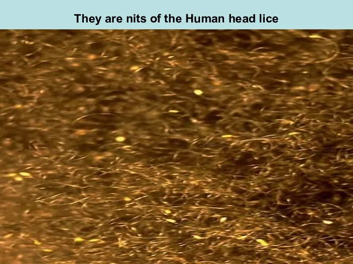 They are nits of the Human head lice