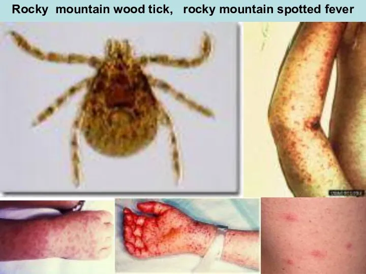 Rocky mountain wood tick, rocky mountain spotted fever