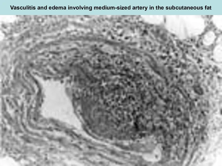 Vasculitis and edema involving medium-sized artery in the subcutaneous fat